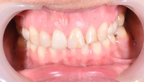 Licówki zębów