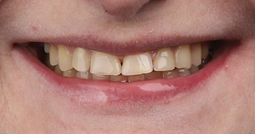 Leczenie kanałowe w 1 dzień Leczenie kanałowe w 1 dzień