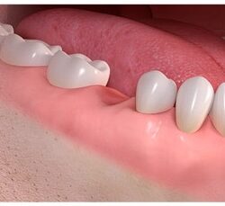 Implanty Opole implant zęba Opole