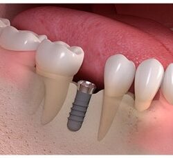 Implanty Opole implant zęba Opole