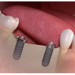 Implanty Opole mosty zębowe na implantach Opole
