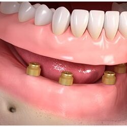 Implanty Opole Proteza zębowa na implantach Opole
