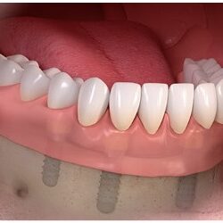 Implanty Opole Proteza zębowa na implantach Opole