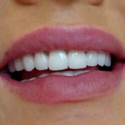 Licówki zębów Licówki zębowe Opole