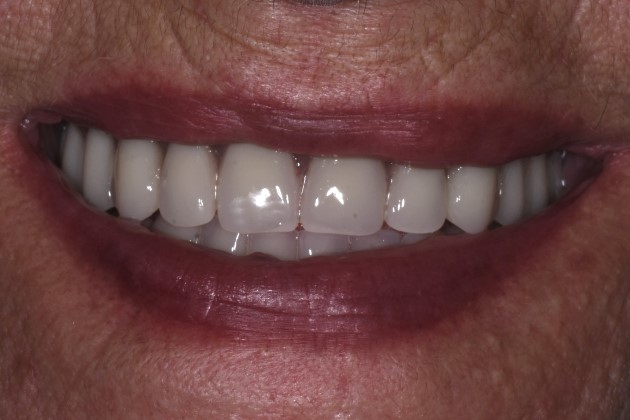 Protezy zębowe Protezy zębowe