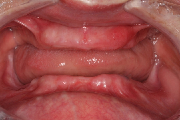 Protezy zębowe Protezy zębowe