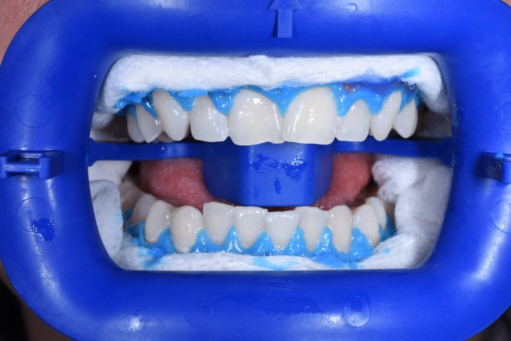 laserowe wybielanie zębów opole